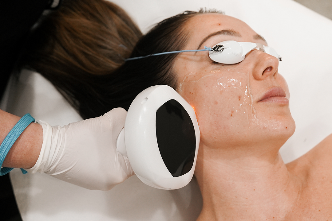 Meccaderm Lumecca IPL Melbourne (Non-Invasive) – The Derm Loft